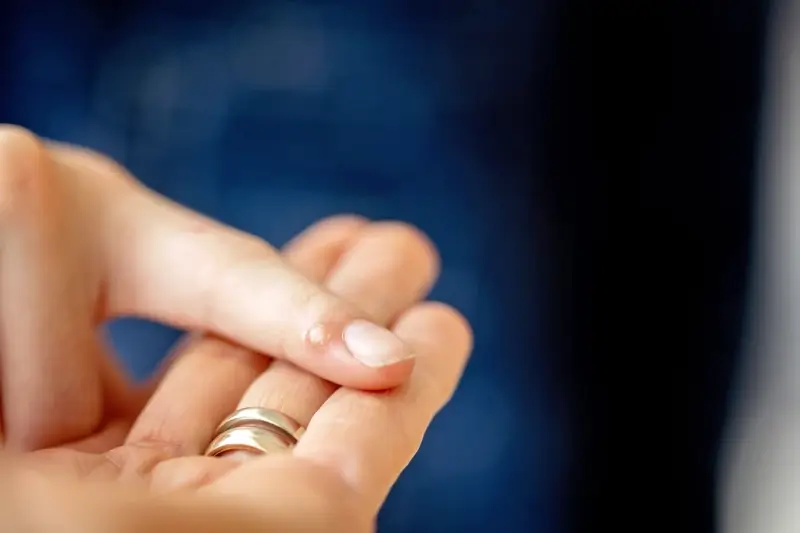 Co dobrego na kurzajki dla dzieci?